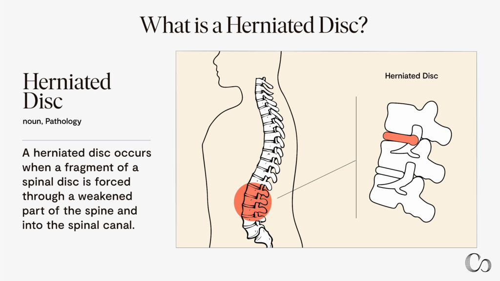 What is a herniated disc? A herniated disco occurs when a fragment of a spinal disc is forced through a weakened part of the spine and into the spinal canal.