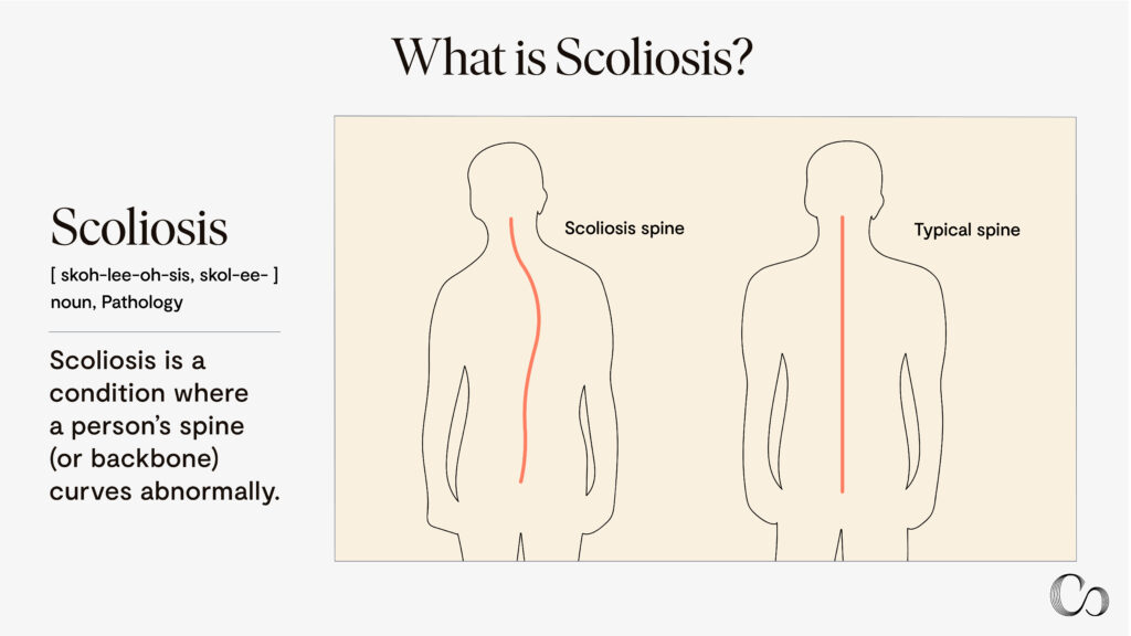 Scoliosis surgery: What is scoliosis? Scoliosis is a condition where a person's spine (or backbone) curves abnormally.