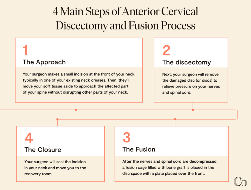 Acdf Surgery Incision Anterior Cervical Discectomy & Fusion (ACDF) for Neck Pain - Commons Clinic