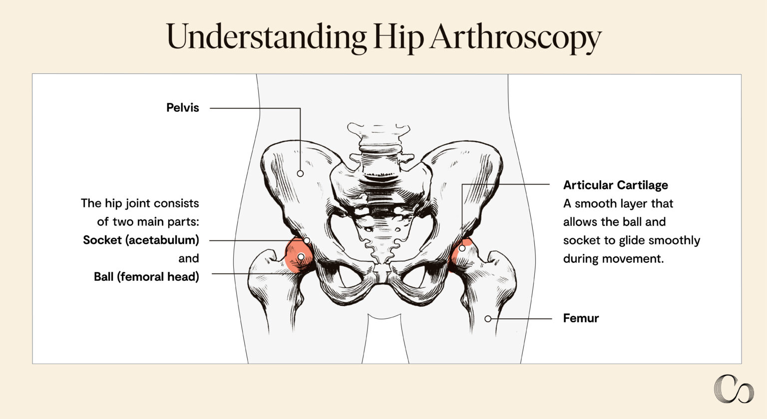 Hip Arthroscopy 101 — Procedure and Recovery Guide - Commons Clinic