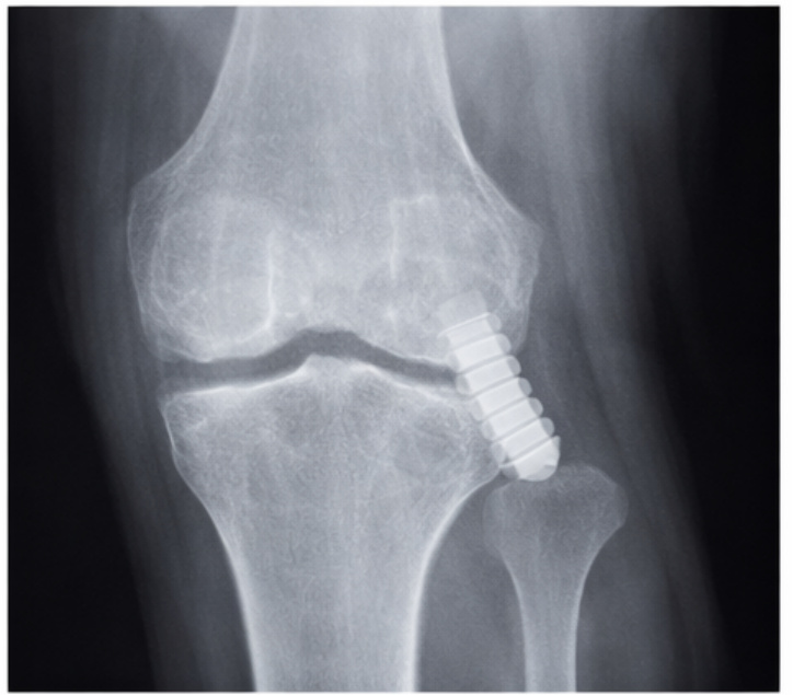 X ray showing knee after ACL reconstruction surgery acl surgery anterior cruciate ligament reconstruction rehabilitation hamstring tendon patellar tendon anterior cruciate ligament reconstruction acl operation acl surgery patellar tendon allograft acl reconstruction acl reconstruction surgery acl surgery implant anterior cruciate ligament reconstruction acl reconstruction postoperative care acl reconstruction rehabilitation acl reconstruction implant anterior cruciate ligament reconstruction acl reconstruction recovery acl reconstruction acl reconstruction acl reconstruction quadriceps tendon acl tears acl tears acl injuries physical therapist acl reconstruction acl surgery acl reconstruction acl reconstruction acl reconstruct acl injuries acl reconstruction acl reconstruction acl reconstruction acl reconstruction surgery anterior cruciate ligament reconstruction acl reconstruction surgery acl reconstruction acl operation acl reconstructive surgery acl reconstruction implant acl operation acl surgery acl reconstruction surgical technique acl reconstruction rehabilitation acl reconstruction acl reconstruction anterior cruciate ligament reconstruction acl reconstruction quad tendon acl reconstruction rehabilitation acl reconstruction acl reconstruction torn acl torn acl acl reconstruction acl surgery physical therapist acl reconstruction torn acl acl surgery acl reconstruction acl reconstruction acl reconstruction surgery acl reconstruction surgery acl reconstruction acl reconstruction surgery acl surgery quadriceps tendon hamstring tendon acl reconstruction acl reconstruction surgery acl reconstruction surgery orthopedic surgeon rehabilitation acl reconstruction anterior cruciate ligament reconstruction patellar tendon acl reconstruction rehabilitation quad tendon acl reconstruction anterior cruciate ligament reconstruction acl reconstructive surgery physical therapist implant torn acl acl surgery acl reconstruction recovery acl reconstruction anterior cruciate ligament reconstruction orthopedic surgeon implant acl reconstruction acl reconstruction acl reconstruction allograft quad tendon acl reconstruction surgery acl reconstruction rehabilitation acl surgery acl reconstruction implant acl reconstruction surgeon acl reconstruction acl reconstruction acl reconstruction acl injury acl reconstruction rehabilitation allograft acl reconstruction acl reconstruction acl reconstruction acl reconstructive surgery acl reconstruction surgery acl reconstruction surgery rehabilitation acl reconstruction acl reconstruction surgery acl reconstruction surgery anterior cruciate ligament tears implant autograft acl procedure acl reconstruction acl reconstruction acl reconstruction surgery hamstring tendon allograft acl reconstruction torn acl acl reconstruction acl surgery acl surgery quad tendon acl reconstruction surgery allograft acl reconstruction acl reconstruction torn acl patellar tendon implant physical therapist patellar tendon acl reconstruction acl reconstruction surgery quadriceps tendon acl reconstruction acl surgery acl reconstruction quadriceps tendon anterior cruciate ligament reconstruction crutches acl reconstruction acl injury anterior cruciate ligament reconstruction physical therapist acl reconstruction surgery acl tears patellar tendon acl reconstruction anterior cruciate ligament reconstruction acl reconstruction patellar tendon autograft implant acl reconstruction acl reconstruction surgery acl injuries