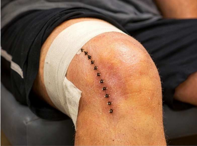 Close up of knee after LCL reconstruction surgery with stitches and bandage during recovery surgery lateral collateral ligament reconstruction surgery surgery knee replacement surgery knee lcl reconstruction surgery surgery surgery knee lcl reconstruction surgery surgery surgery surgery lateral collateral ligament reconstruction knee lcl reconstruction